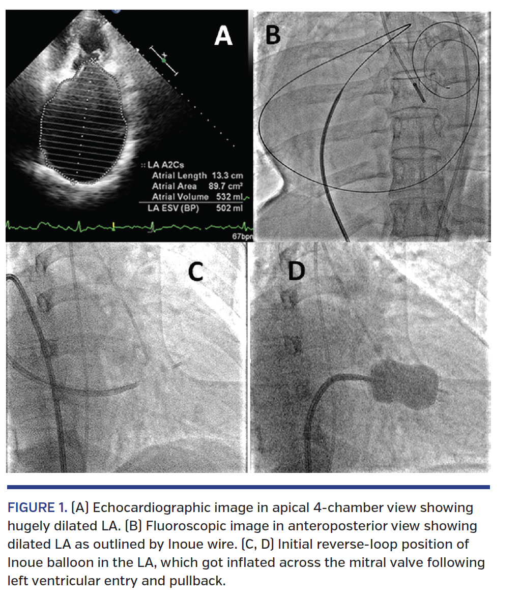 ReverseLoop Technique for Percutaneous Transvenous Mitral